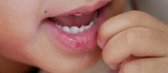 Lèvres sèches de vos enfants